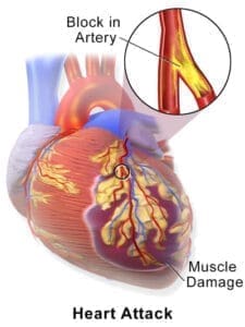 Infarctus