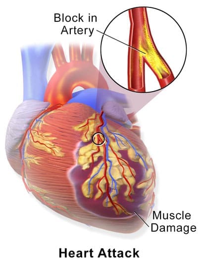 Infarctus